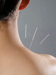 ¿Qué es microneedling y para qué se utiliza?
