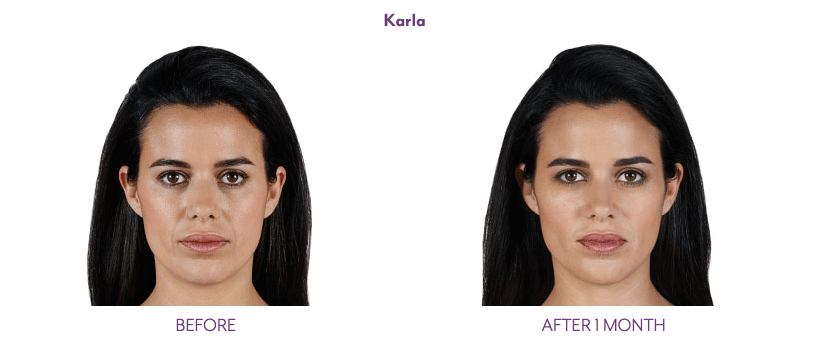 Juvederm Volift antes y después