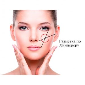 Corrección de mejillas y pómulos